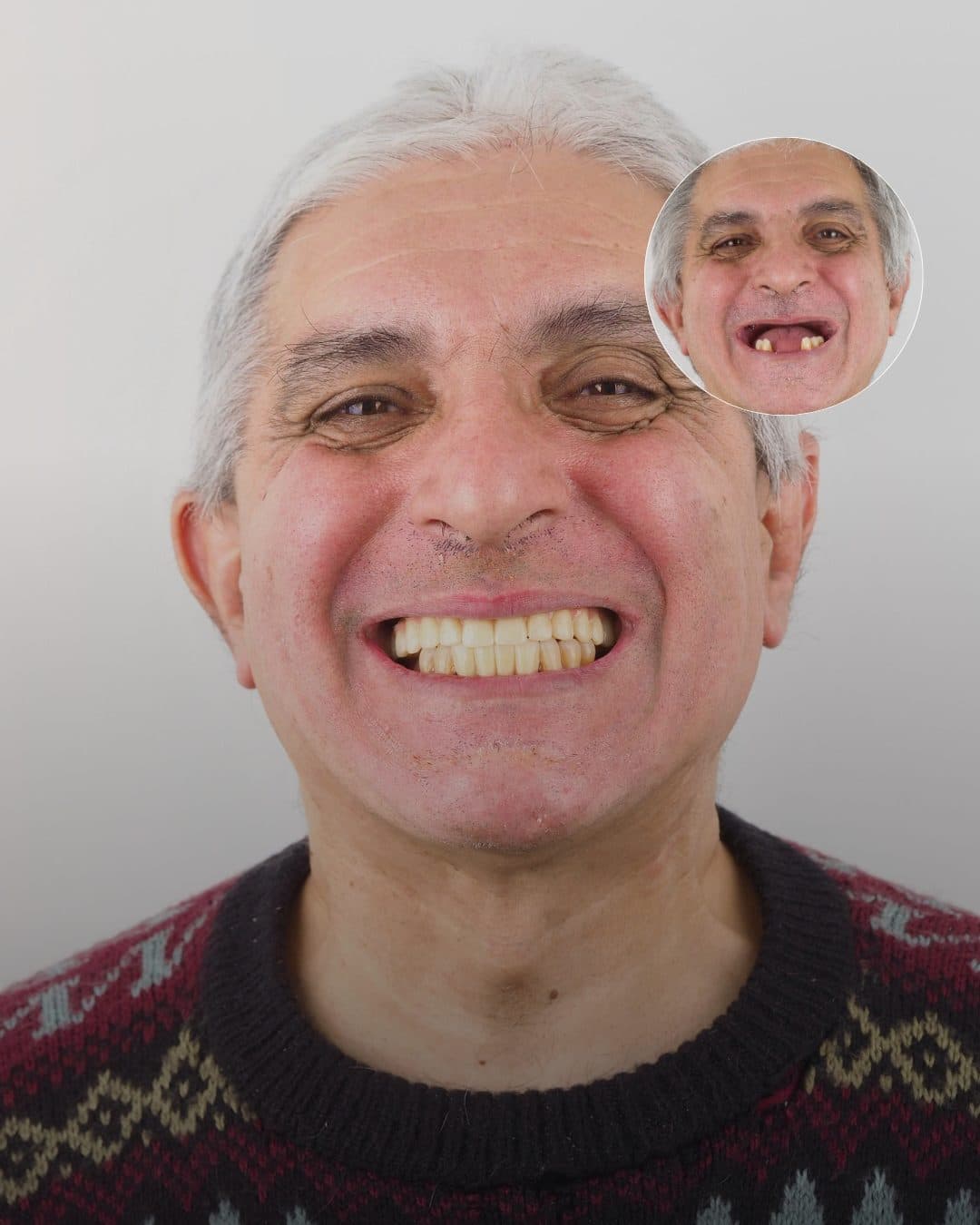 Antes y después · Recuperó su sonrisa con una rehabilitación completa