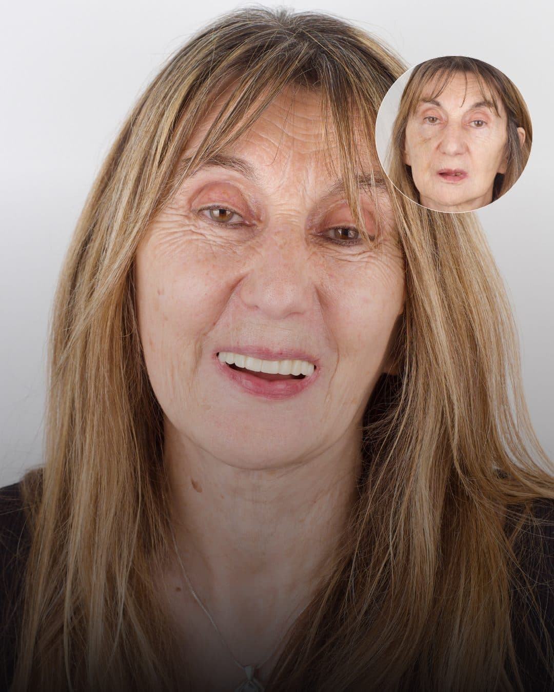 Antes y después · Volvió a sonreír con naturalidad