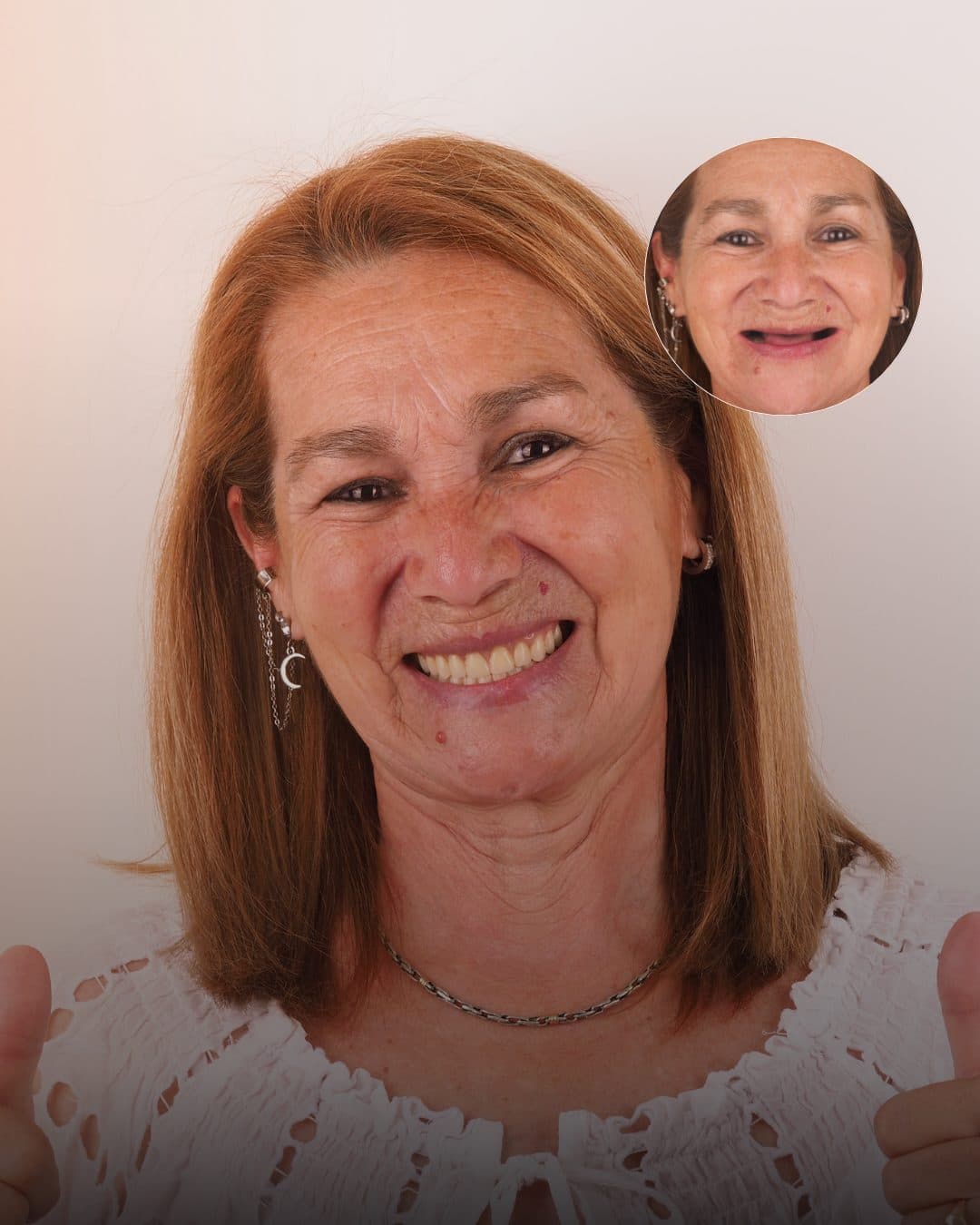 Antes y después · Prótesis a medida, estética y funcional