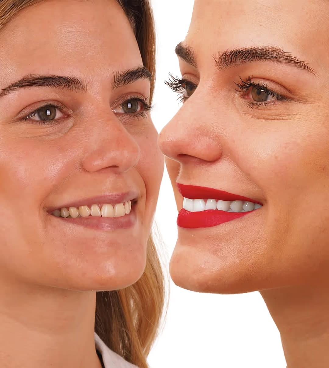 Comparación de una sonrisa antes y después de un blanqueamiento dental en Zuro Dental