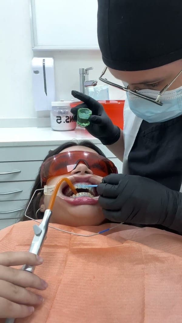 Blanqueamiento en consultorio