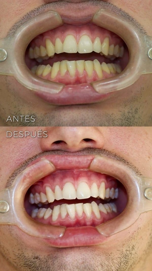 Blanqueamiento dental en Zuro Dental