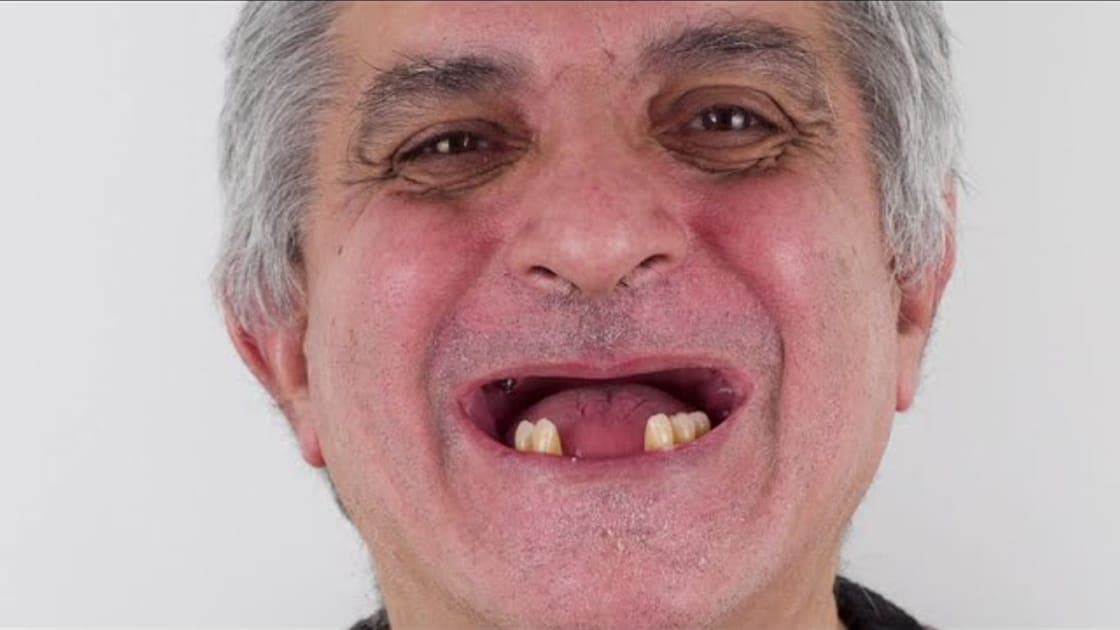 Rehabilitación de una sonrisa
