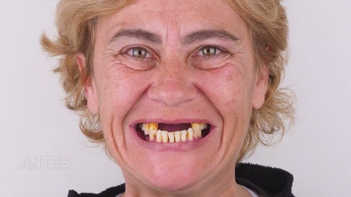 Recuperación de piezas dentales