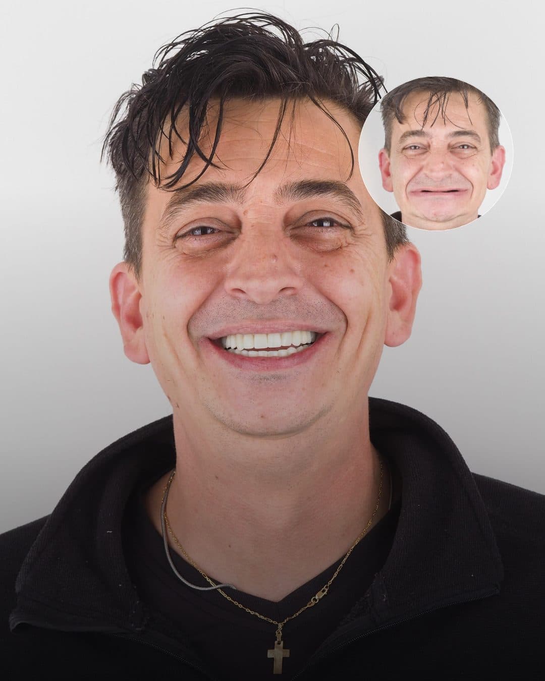 Antes y después de un paciente de Zuro Dental que recuperó su sonrisa con una prótesis dental