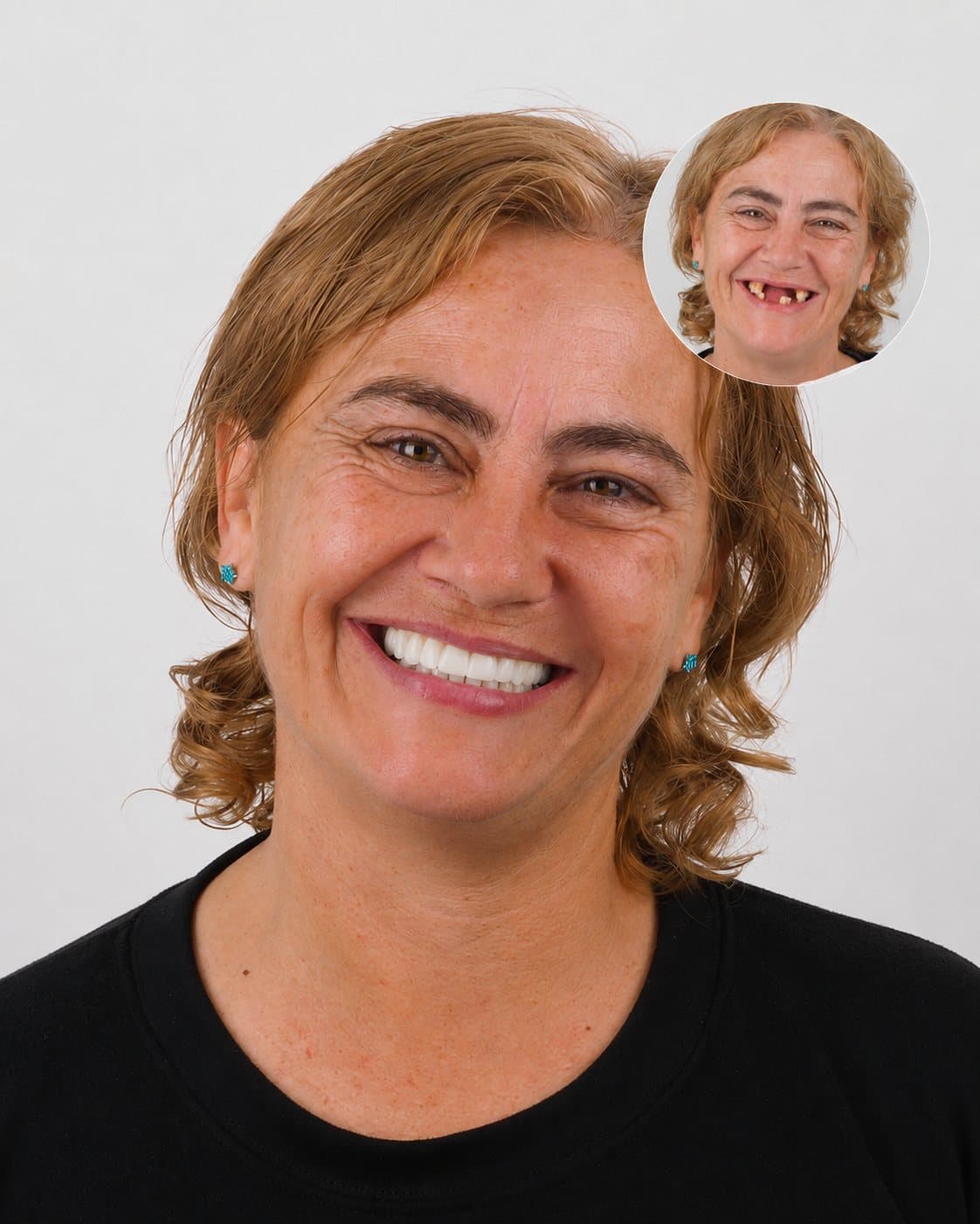 Antes y después de una paciente de Zuro Dental que recuperó sus dientes: de varias piezas faltantes a una sonrisa completa
