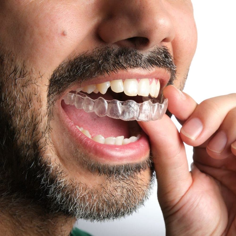 Paciente colocándose un alineador invisible Muna en la clínica Zuro Dental